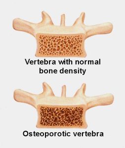what is osteoporosis classes at southside physiotherapy clinic